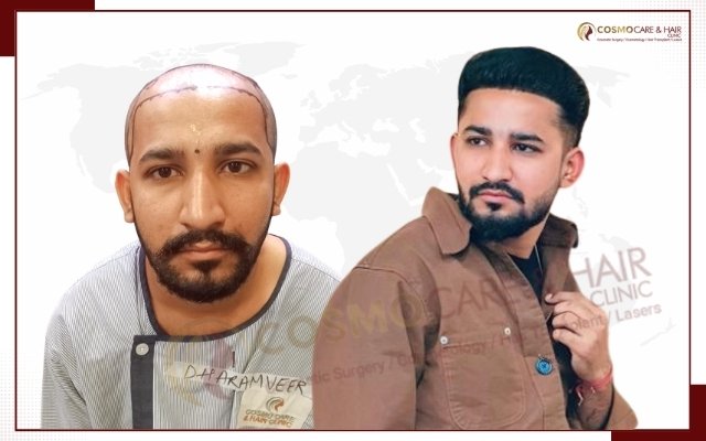 Before hair transplant, receding hairline